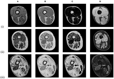 Automated MRI quantification of volumetric per-muscle fat fractions in the proximal leg of patients with muscular dystrophies